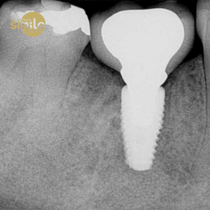 What is a dental implant in Brisbane - expert tooth replacement solution at The Aesthetics Smile Collective