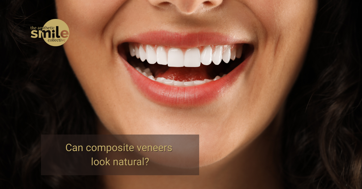 Can composite veneers look natural? Discover natural-looking smile makeovers at The Aesthetic Smile Collective in Clayfield Brisbane.