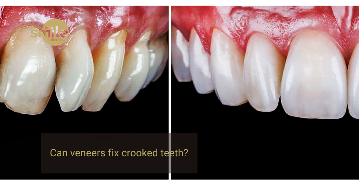 Can veneers fix crooked teeth – The Aesthetic Smile Collective Brisbane