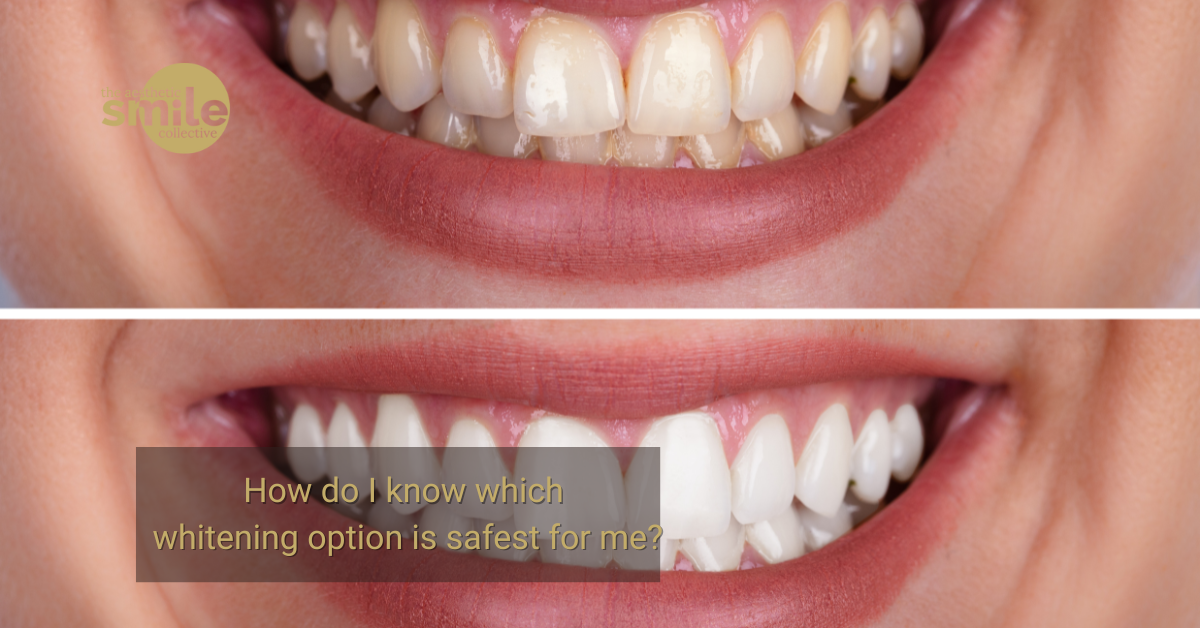 How to choose the safest teeth whitening option in Brisbane at The Aesthetic Smile Collective