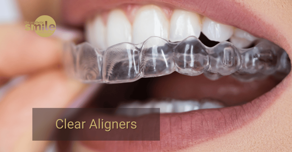 Clear aligners in Brisbane showing treatment stages, costs and timeline for achieving a straighter smile.
