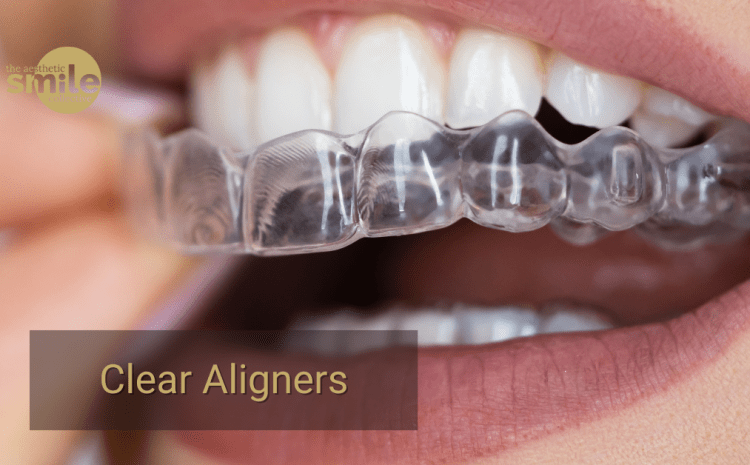  Clear Aligners in Brisbane: Costs, Timeline and What to Expect at Every Stage