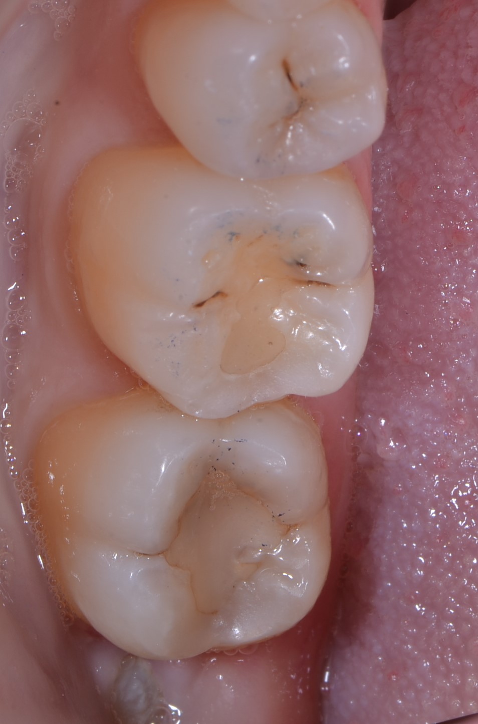 Before Treatment