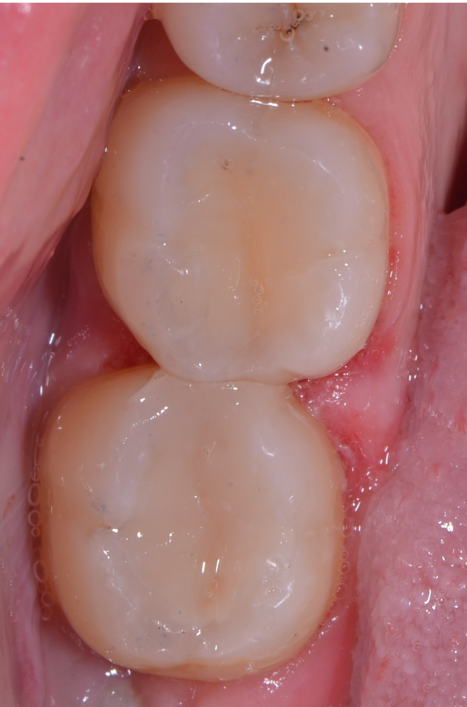 After Treatment